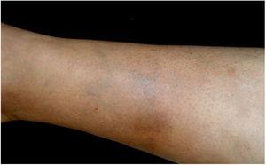 Sclerosing panniculitis with recurrent anemia. Sclerosing panniculitis in the right leg of a 32-year-old woman with a history of recurrent anemia of unknown origin. The patient subsequently tested for positive B. henselae DNA in blood samples.