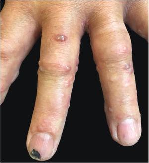 Multiple vesicular lesions affecting the left forearm and left hand.