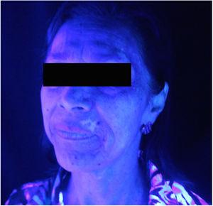 Vitiligo on the face, front position (Wood's light examination).