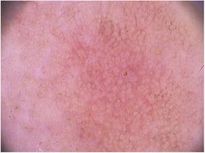 Dermoscopic image (FotoFinder®, x20) of the “strawberry” pattern observed in facial actinic keratosis.