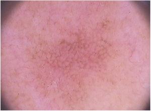 Dermoscopy of facial pigmented actinic keratosis (FotoFinder®, x20): a brownish pseudonetwork that spares follicular ostia is observed, in addition to surface scales and underlying vascular pseudonetwork.