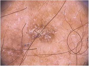 Dermoscopy of extra-facial pigmented actinic keratosis located on the forearm: homogenous brownish pigment with whitish scales on the lesion surface can be observed (FotoFinder®, x20).