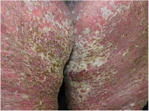 Diffuse erythema, vesicular lesions, erosions, and crusts in lower limbs close to inguinal folds.