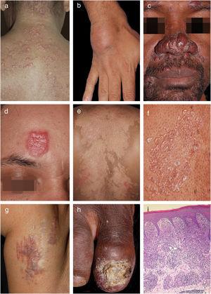 Clinical examples of cutaneous sarcoidosis: A, Papular form; B, Subcutaneous form; C, Lupus pernio; D, Angiolupoid; E, Hypochromic form; F, Lichenoid lesions; G, Ancient scar lesions; H, Periungual infiltration with osteitis and nail dystrophy; I, Granulomas composed predominantly of epithelioid histiocytes (Hematoxylin & eosin, x40 ).