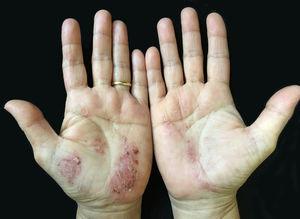 Desquamation and brown discoloration on erythematous skin of palms.