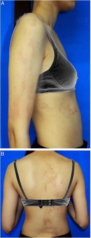 (A) Linear hyperpigmented patches on the right arm and right trunk following Blaschko's lines. (B) Linear hyperpigmented patches on the right arm and right trunk following Blaschko's lines.
