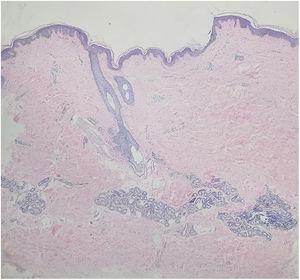 A normal epidermis with increased pigmentation of the basal layer, with more compact dermal collagen and mild upper dermal perivascular lymphocytic infiltration (Hematoxylin & eosin, ×40).