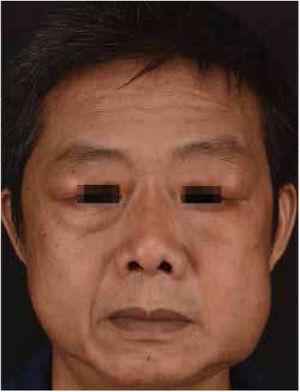Fullness of the bilateral upper eyelids and swelling in the bilateral parotid regions.