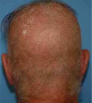 Extensive scalp involvement, with numerous whitish and spiky hyperkeratotic follicular papules, and alopecia.