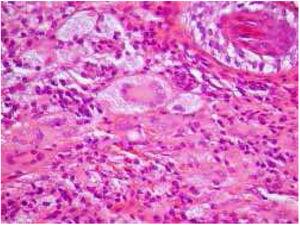 Infiltration circumscribed of the dermis by xanthomized histiocytes and multinucleated Touton giant cells (Hematoxylin & eosin, ×400).