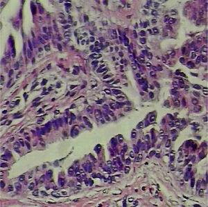 Histopathological examination: cystic cavity coated by basal cuboidal cells and columnar apocrine cells (Hematoxylin & eosin, ×400).