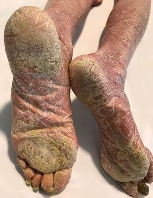 Bilateral leg erythema and plantar keratoderma.