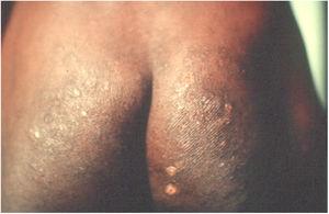 Onchocerciasis. Intense pruritus, presence of lichenification, exulcerations, and hyperpigmentation. Patient from the Infectious Disease Clinic, Ibadan, Nigeria (personal archive: Prof. Dr. Sinésio Talhari).