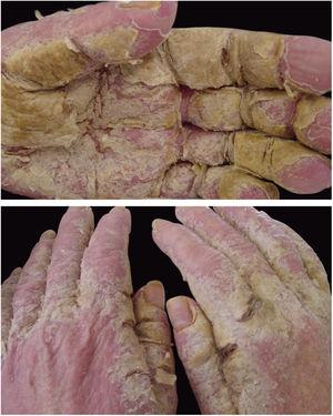 Crusted scabies. Intense, constant pruritus and generalized erythematous, squamous lesions. HTLV+ patient. Personl archive: Dr. Paulo Roberto Machado.