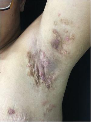 Injuries suggestive of hidradenitis suppurativa in the axilla: nodules, scars and fibrosis.