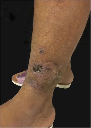 Ulcerated cicatricial lesion in lower left limb of pyoderma gangrenosum.