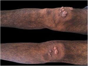 Brownish nodular lesions on the knees.