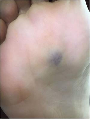 Violaceous lesion, with poorly defined limits, on the sole of the right foot.