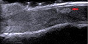 HFUS, 22MHz, longitudinal view (Case 3). Hyperechogenic, heterogeneous area with irregular shape (arrow), avascular, located in the nail bed with Doppler mapping.