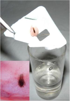 Material obtained by shaving, and dermoscopy of the nail matrix (Case 2). After shaving, the material is supported on paper before being placed in the formalin. In the nail matrix there is a small area with irregular bands of dark brown pigmentation and globules in the proximal portion.