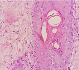 Dyskeratosis and multinucleated giant cells in follicular epithelia (Hematoxylin & eosin, ×400).