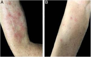 Erythematous papules with pruritus and excoriation in right arm (A) and forearm (B).