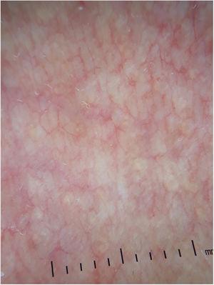 Multiple whitish non-follicular papules, coalescing into plaques with linear vessels, on dermoscopy.