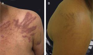Flagellate dermatitis associated to bleomycin treatment: (A) pruritic erythematous linear streaks, (B) followed by linear pigmentation.