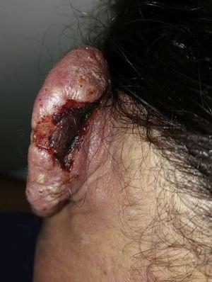 Cutaneous lesion in the posterior region of the left ear.
