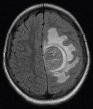Presence of a single solid expansive lesion measuring 5cm×3.5cm in the left fronto-parietal region, associated with an intense vasogenic edema, promoting midline deviation.