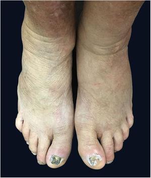 Dystrophic fingernails on toes and malleolar edema.