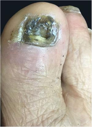 Desquamation and nail pigmentation in the hallux.