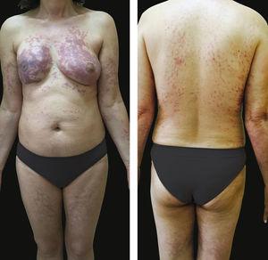 Erythematous/purple patches on the breasts, back and limbs.