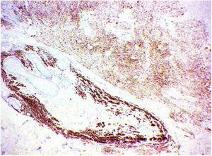 Immunohistochemical study demonstrating positivity for Melan A confirming the melanocytic nature of the lesion.