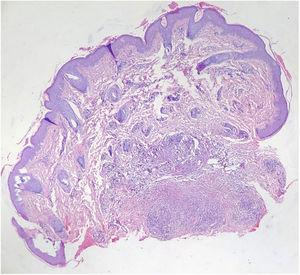 Histology showing irregular epidermal hyperplasia, dermal vascular endothelial cell swelling and vascular stenosis with moderate perivascular lymphocytic infiltration, and laminated fibrosis with granulomatous infiltration of epithelioid cells and lymphocytes (Hematoxylin & eosin, ×40).