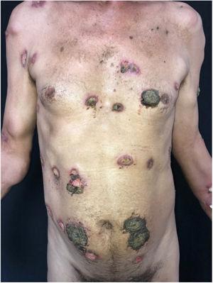 Skin-colored and erythematous nodules and ulcers covered with thick, blackened crusts.