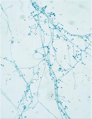 Hyaline, septate, branched and regular hyphae. Pyriform conidia arranged like a daisy flower at the end of the conidiophores.