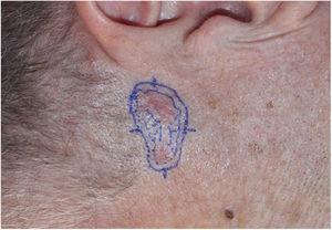 Basal cell carcinoma. A poorly delimited and noncontiguous lesion measuring 20×28mm on the left preauricular area.
