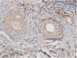 Representative discoid lupus erythematosus case: CD123 immunohistochemistry presence of PDCs at the intrafollicular and perifollicular area (40×).