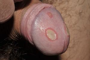 Shallow ulcers on the penis, with fibrin-containing floor.
