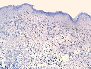 CD7 reaction is negative in both compartments, characterizing loss of that T-cell marker and dermoepidermal disagreement, regarding CD3 positivity (Immunohistochemistry, x40).