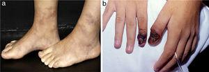 Distinct lesions normally found on the skin of patients with medium vessel vasculitis: (a) Livedo racemosa in the lower limbs, including the dorsum of the feet in a patient with cutaneous arteritis, (b) Digital necrosis in a patients with ANCA-associated vasculitis - granulomatosis with polyangiitis.