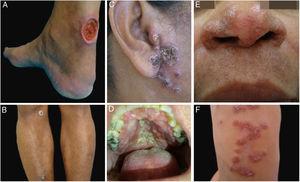 Clinical examples of patients with clinical lesions for which polymerase chain reaction high-resolution melting (PCR-HRM) assessment was able to determine the species of Leishmania. A, Patient 11 (L. infantum chagasi); B, Patient 13 (L. amazonensis+L. infantum chagasi); C, Patient 14 (L. amazonensis+L. infantum chagasi); D, Patient 7 (L. brasiliensis); E, Patient 3 (L. amazonensis); F, Patient 5 (L. amazonensis). (Figure not visible).