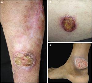 Clinical images of lesions for which polymerase chain reaction high-resolution melting (PCR-HRM) assessment was unable to determine the species of Leishmania. A, Patient 17, ulcer in the upper limb; B, Patient 21, ulcer in the lower limb whose biopsy showed the presence of amastigotes in the tissue; C, Patient 21, ulcer in the lower limb.