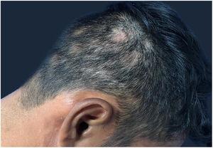 Areas of non-scarring alopecia on the scalp.