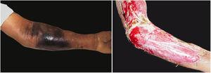Necrotizing fasciitis after manipulation of furunculoid myiasis. (A) Presence of edema, mild erythema, and extensive area of necrosis. (B) Debridement product in which necrosis foci are still observed.