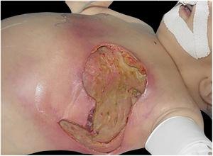 Necrotizing fasciitis in a nursing infant after an attempt to squeeze dripping milk from the nipple. The area was debrided until the muscle plane, with removal of the fascia. Presence of infectious activity an area of the chest.