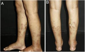 Nodular vasculitis: the posterolateral regions of the legs are affected by nodules and violaceous plaques. A bandage was placed where a skin biopsy had been done a few days earlier.