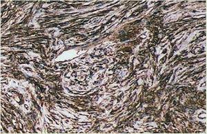 Immunohistochemistry: diffuse positivity for CD34 in spindle cells with storiform pattern.