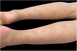 Dermatosis located on the lower limbs, characterized by erythematous and violet nodules of different sizes, more palpable than visible.